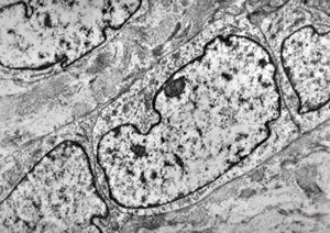 M,1y. | neuroblastoma - submandibular region M,1y. | neuroblastoma - submandibular region
